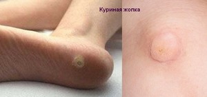 Вирусные бородавки: что это, лечение Вирусные бородавки