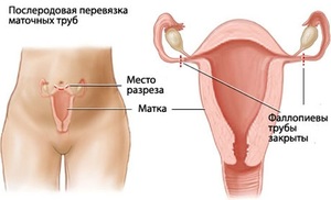 Внематочная беременность