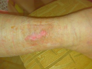 Водействие на рану облепихового масла