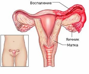 Воспаление придатков у женщин
