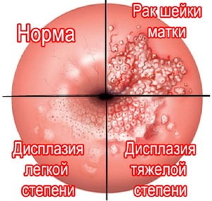 Воспаление шейки матки