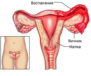 Воспаление яичников рисунок