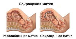 Диагностика тонуса Как вредит плоду тонус