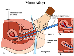 Мини аборт (вакуум) - схема Как выполняется мини аборт ваккумом