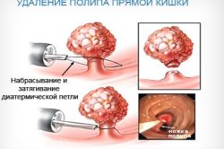 Схема удаления полипа прямой кишки Схема удаления полипа прямой кишки