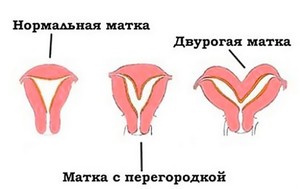 Что нужно знать о матке Заболевания матки
