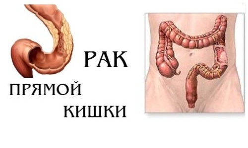 Злокачественная опухоль прямой кишки Злокачественная опухоль прямой кишки