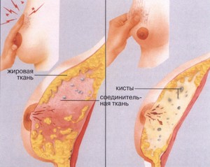 Злокачественные образования