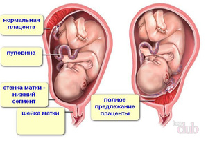 Что означает низкая плацентация Что значит низкая плацентация