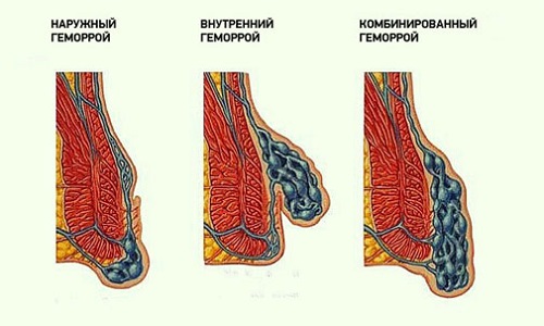 Виды геморроя Виды геморроя