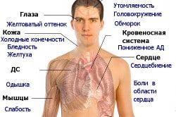 Признаки анемии при геморрое Признаки анемии при геморрое