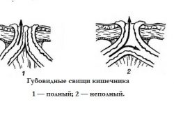 Полный и неполный свищ прямой кишки Полный и неполный свищ прямой кишки