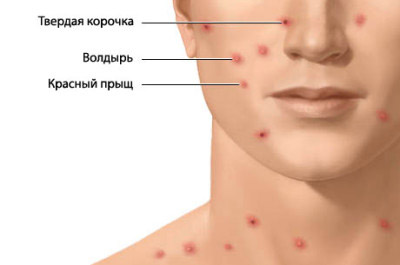 сыпь на лице сыпь на лице