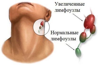 увеличение лимфоузлов увеличение лимфоузлов